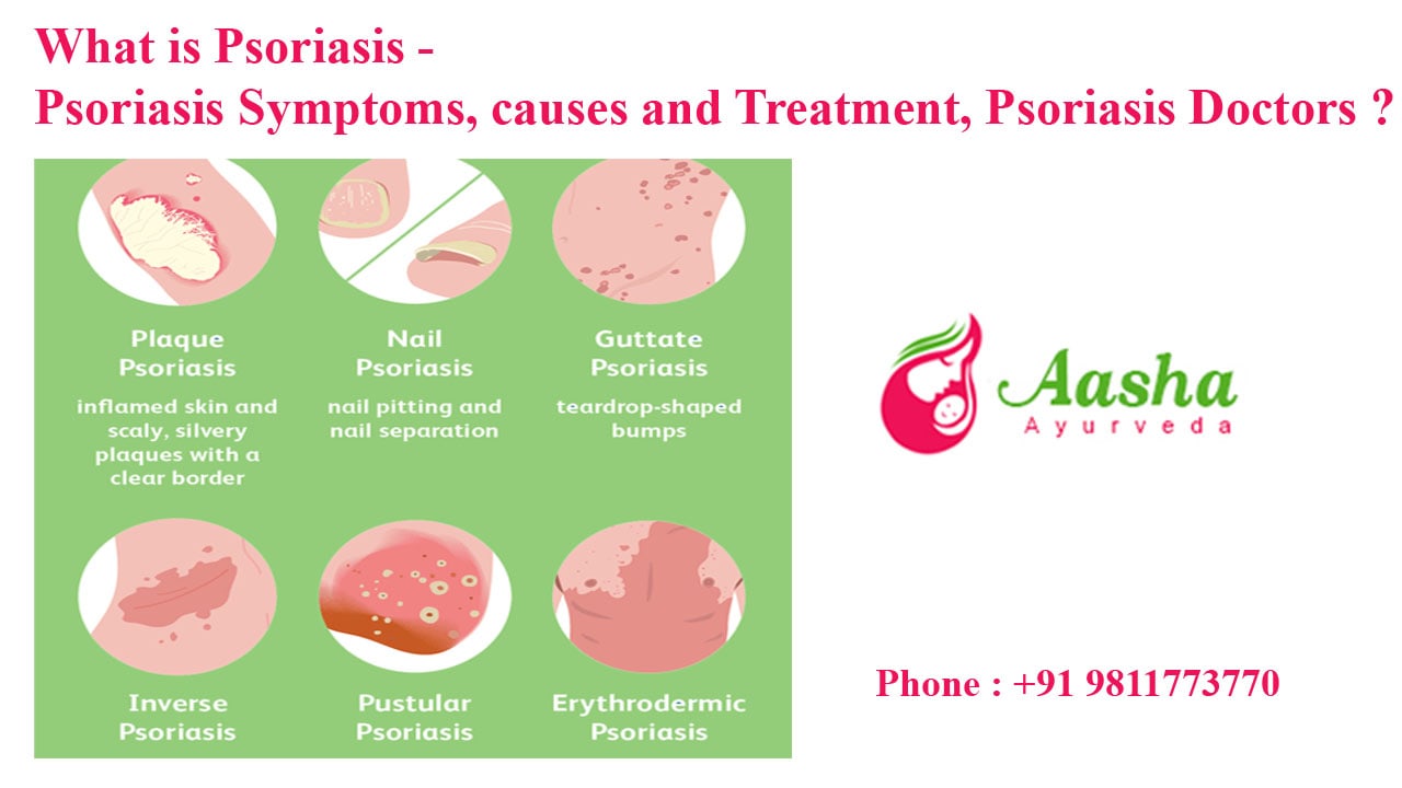 What is Psoriasis - Psoriasis Symptoms, causes and Treatment, Psoriasis Doctors ?
