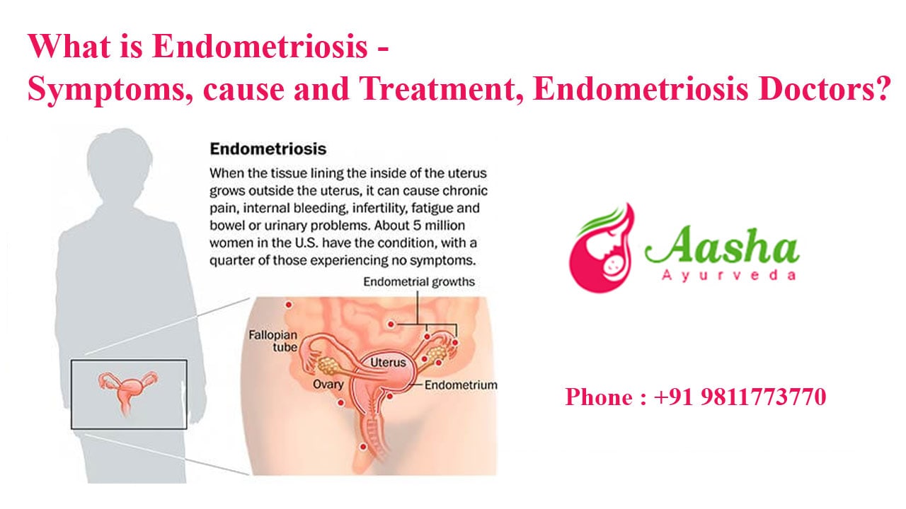 What is Endometriosis - Symptoms, cause and Treatment, Endometriosis Doctors?