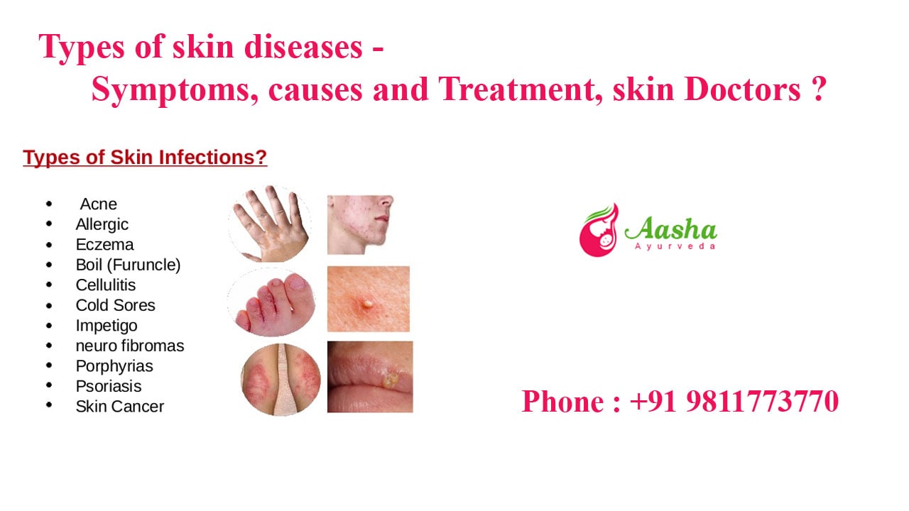 Types of skin diseases - Symptoms, causes and Treatment, skin Doctors ?