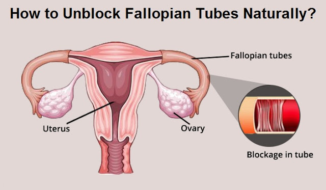 Easy Way to Unblock Fallopian Tubes