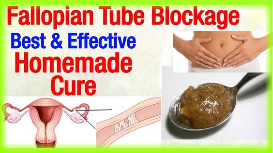 Natural Treatment for Blocked Fallopian Tubes: 18 Things to Try