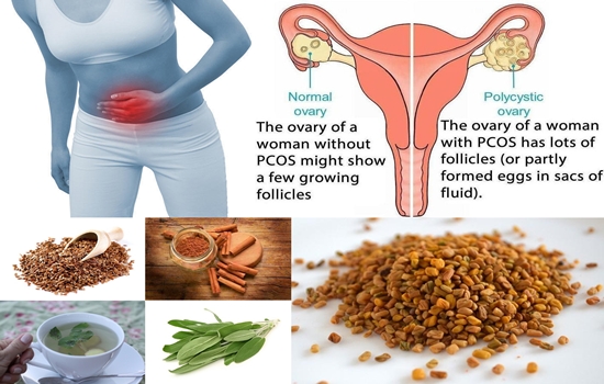 Best natural ways to treat PCOS