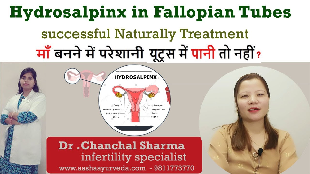 Treat Hydrosalpinx (Fallopian Tube Blockage) without laparoscopy surgery