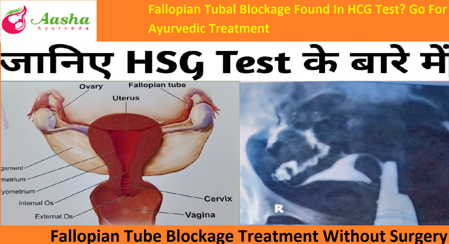 Fallopian Tubal Blockage Found In HCG Test? Go For Ayurvedic Treatment