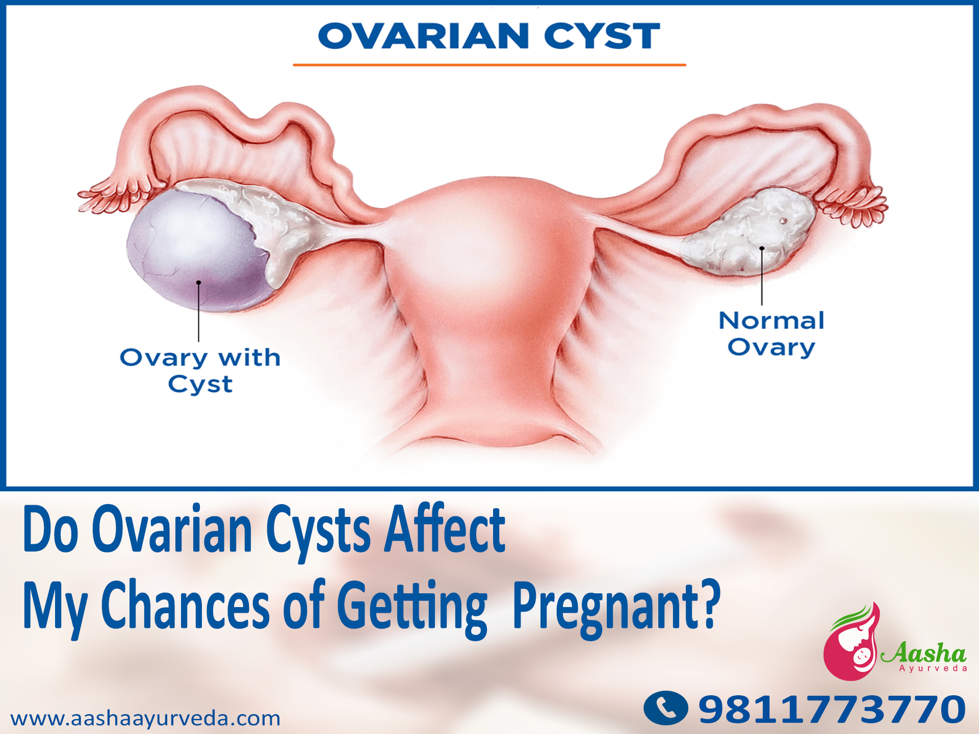 Do Ovarian Cysts Affect My Chances of Getting  Pregnant?