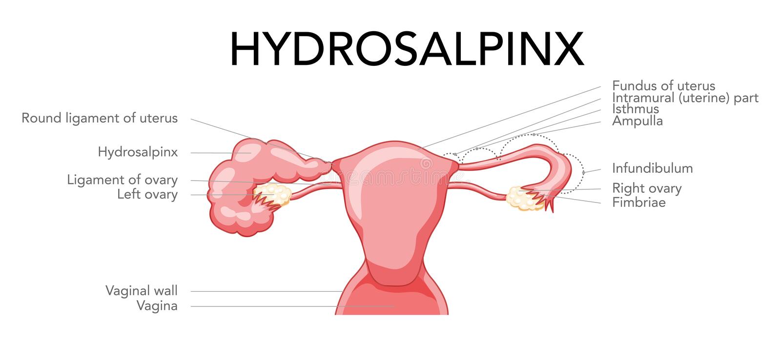 Hydrosalpinx: Causes, Symptoms amd Ayurvedic Treatment | Aasha Ayurveda