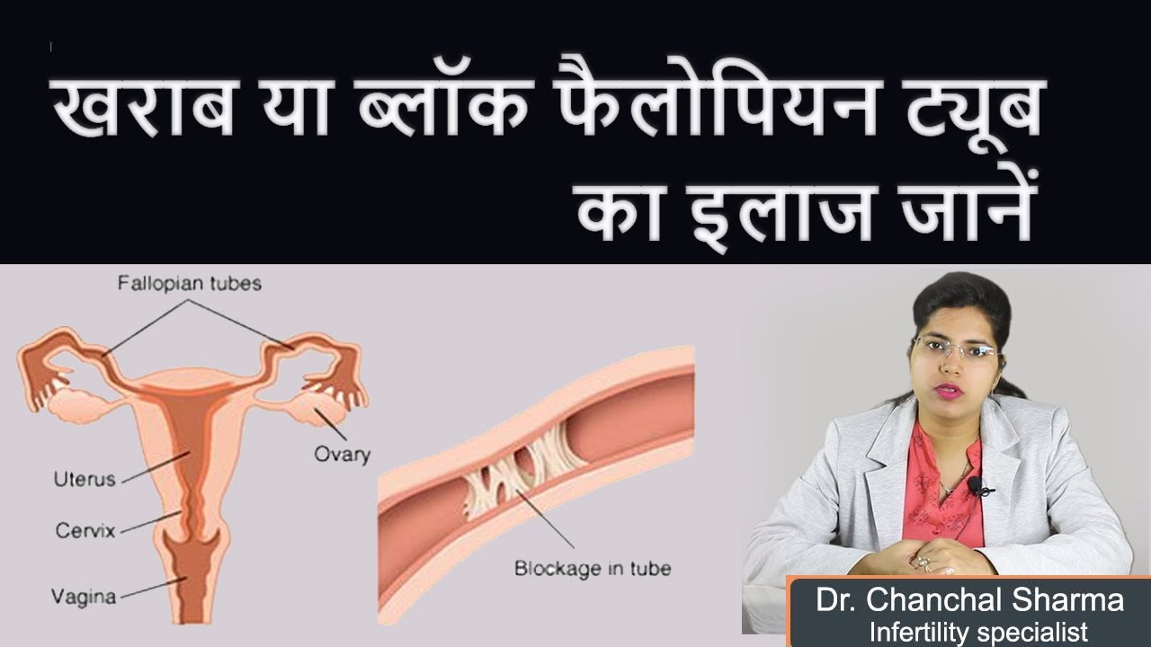 How to get pregnant naturally with blocked tubes? | Ways to open tubal blockage