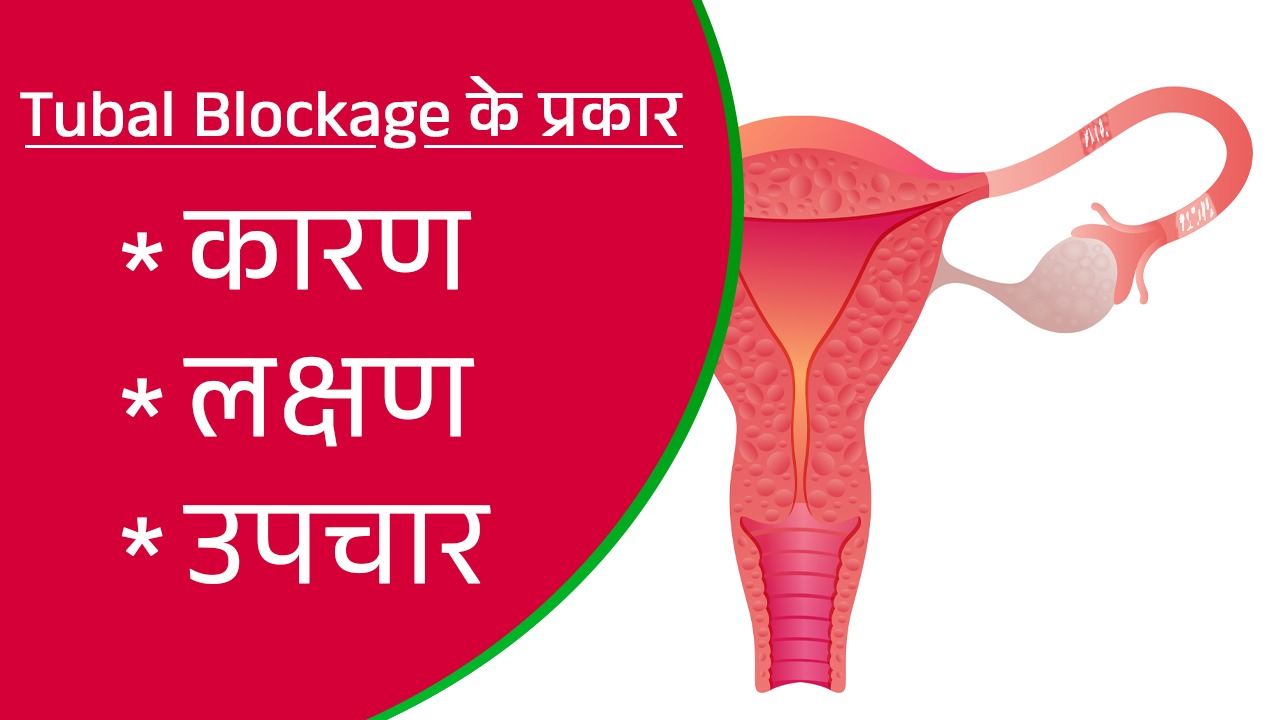 How is a tubal blockage diagnosis | Type of Tubal Blockage