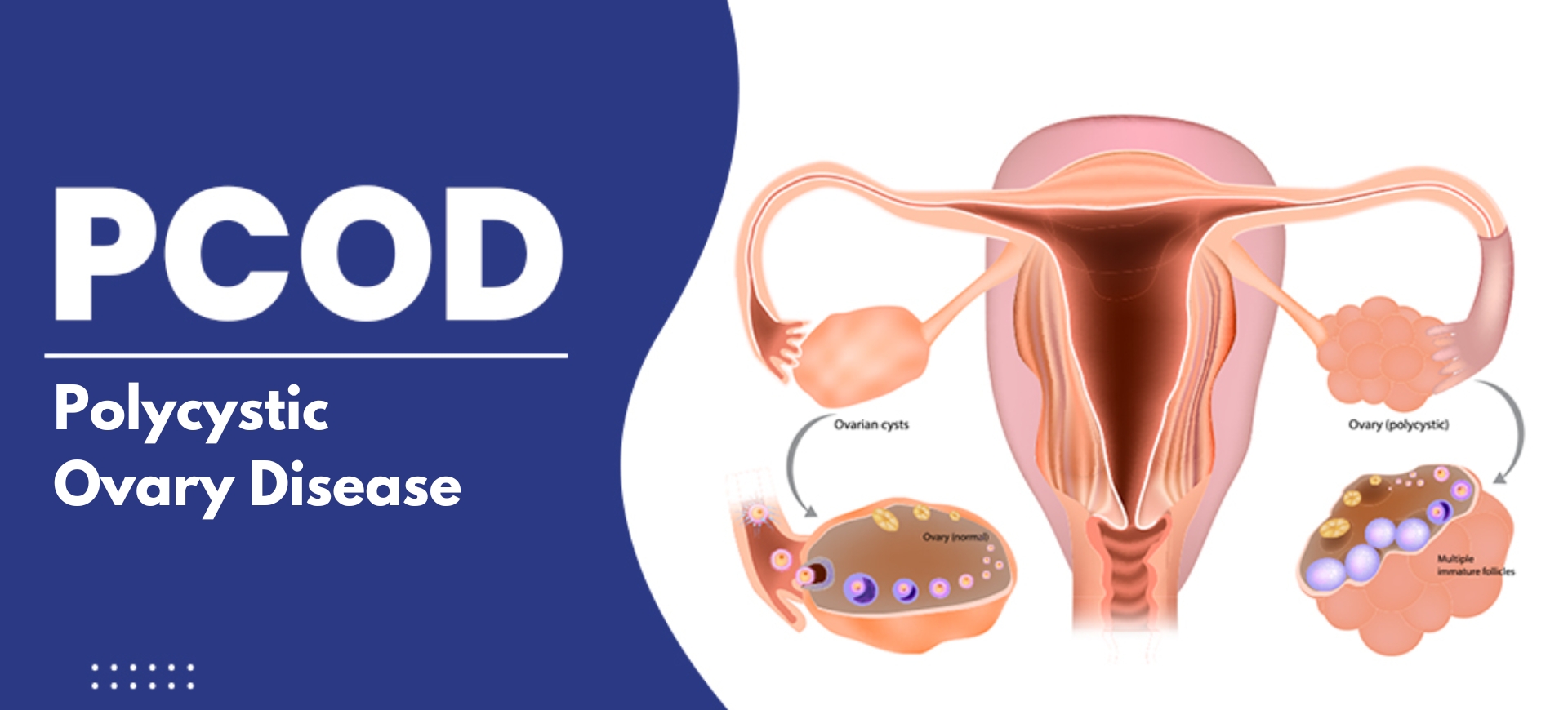 PCOD & PCOS Treatment in Hyderabad Telangana
